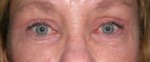 Blepharoplasty