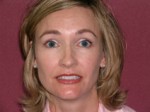Botulinum Toxin