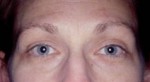 Botulinum Toxin