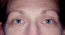 Botulinum Toxin Before and After Photos