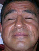 Botulinum Toxin