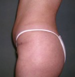 Brazilian Butt Lift
