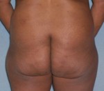 Brazilian Butt Lift