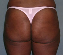 Brazilian Butt Lift Before and After PhotosBrazilian Butt Lift Before and After Photos
