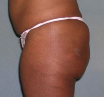 Brazilian Butt Lift Before and After Photos