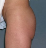 Brazilian Butt Lift