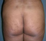 Brazilian Butt Lift