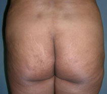 Buttock Lift Result Newark