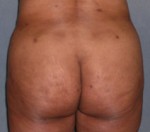 Brazilian Butt Lift