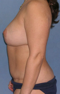 Breast and Abdomen Before and After Photos