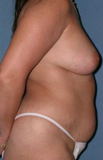 Breast and Abdomen Before and After Photos