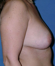 Breast and Abdomen Before and After Photos