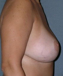 Breast and Abdomen Before and After Photos