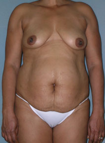 Breast and Abdomen Before and After Photos