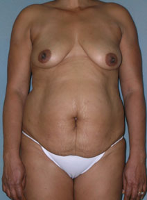 Breast and Abdomen Before and After Photos