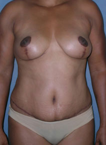 Breast and Abdomen Before and After Photos