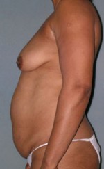 Breast and Abdomen