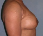 Breast and Abdomen