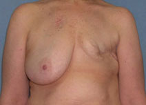 Breast Reconstruction Before and After Photos