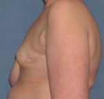 Breast Reconstruction