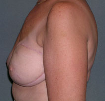 Breast Reconstruction Before and After Photos