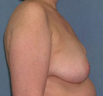 Breast Reconstruction Before and After Photos