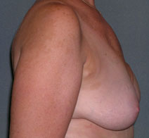 Breast Reconstruction Before and After Photos