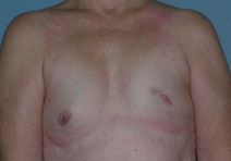 Breast Reconstruction Before and After Photos