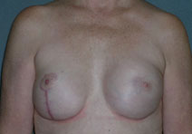 Breast Reconstruction Before and After Photos