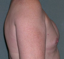 Breast Reconstruction Before and After Photos