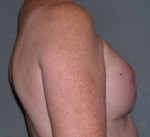 Breast Reconstruction