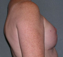 Breast Reconstruction Before and After Photos