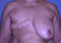 Breast Reconstruction Before and After Photos