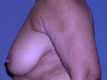 Breast Reconstruction Before and After Photos