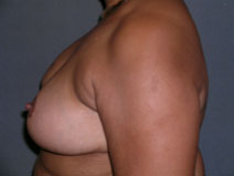 Breast Reconstruction Before and After Photos