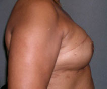 Breast Reconstruction Before and After Photos