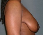 Breast Reduction