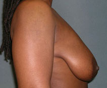 Breast Reduction Case 2790 Before Photo Breast Reduction