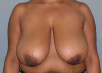Breast Reduction Case 2795 Before Photo Breast Reduction