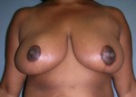 Breast Reduction