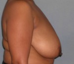 Breast Reduction