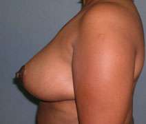 Breast Reduction Case 2795 After Photo Breast Reduction