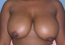 Breast Reduction Case 2802 Before Photo Breast Reduction