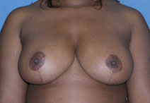 Breast Reduction Case 2802 After Photo Breast Reduction
