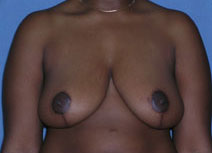 Breast Reduction Case 2807 After Photo Breast Reduction