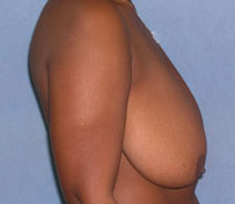 Breast Reduction Case 2807 Before Photo Breast Reduction