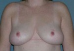 Breast Reduction