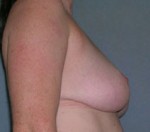 Breast Reduction