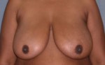 Breast Reduction