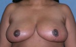 Breast Reduction